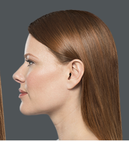 Kybella After